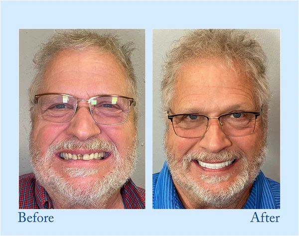 đ„Final 12 Hours: 60%OFFđ BBOJIâą Fluoride-Free Hydroxyapatite Toothpaste đ Your Smile, Naturally Brighter!