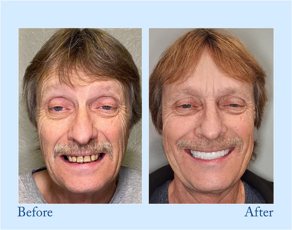 đ„Final 12 Hours: 60%OFFđ BBOJIâą Fluoride-Free Hydroxyapatite Toothpaste đ Your Smile, Naturally Brighter!