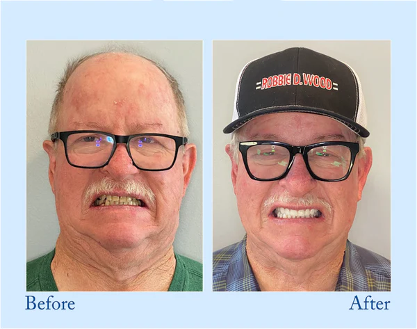 đ„Final 12 Hours: 60%OFFđ BBOJIâą Fluoride-Free Hydroxyapatite Toothpaste đ Your Smile, Naturally Brighter!